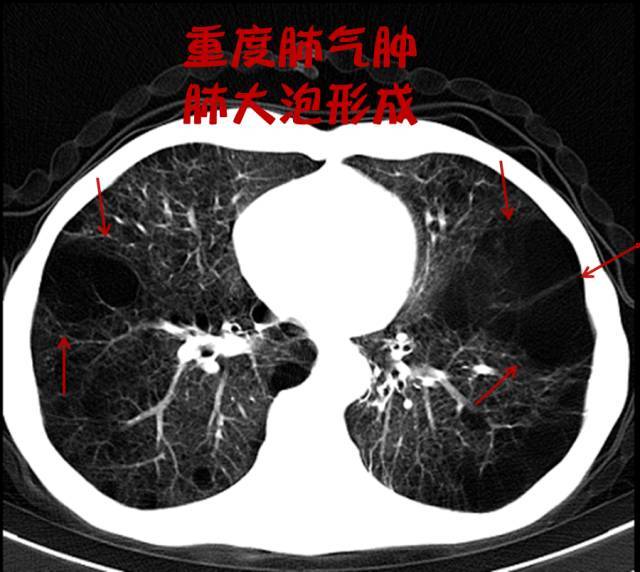 吸烟，其实比雾霾更可怕！不信？有图有真相