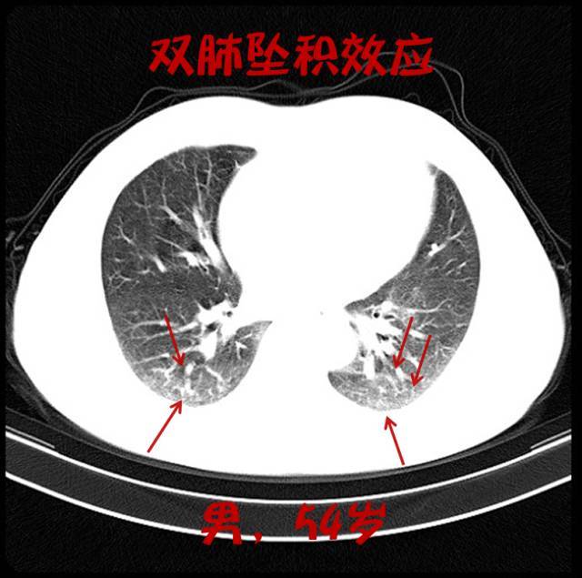 吸烟，其实比雾霾更可怕！不信？有图有真相